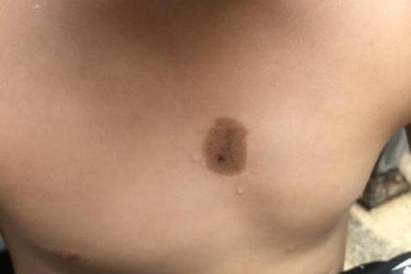 胎记算命介绍