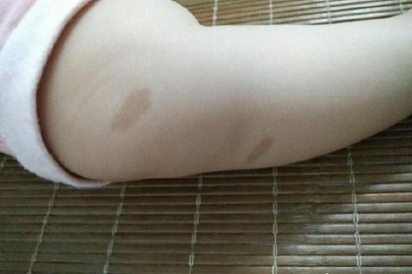 胳膊胎记可以算命吗-