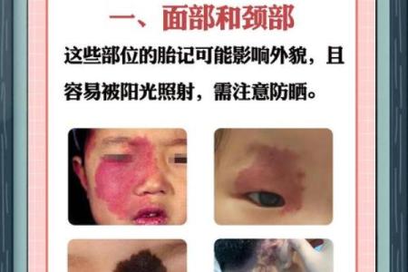 不同部位的胎记算命分析
