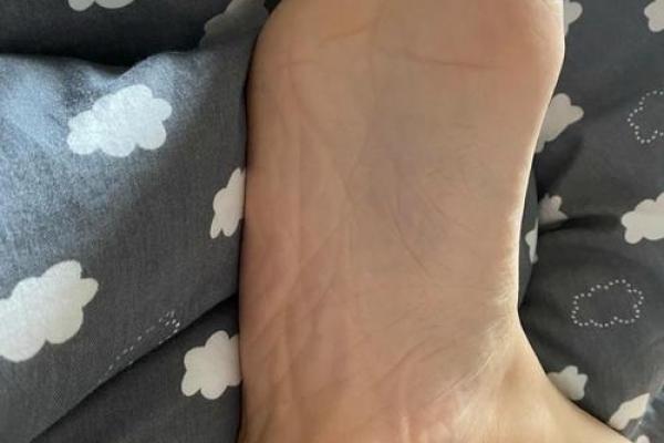 脚上胎记算命，脚底长胎记好不好