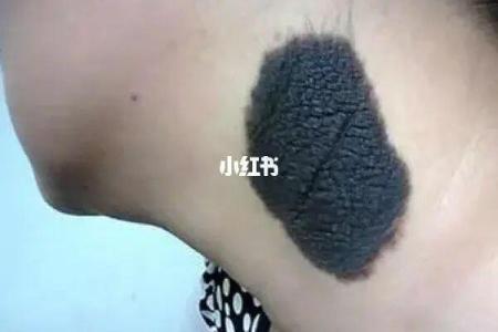 手臂上的胎记算命图解