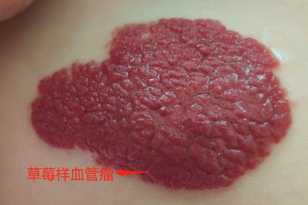 红色胎记算命分析