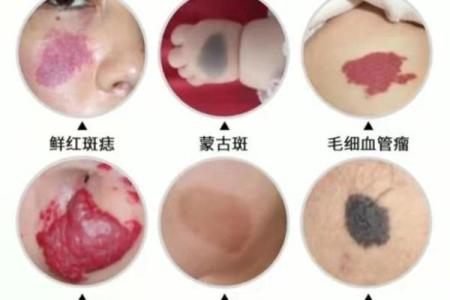 胎记算命图解：什么是红胎记？