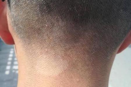 后脑勺有三条竖杠 后脑勺头皮三条竖纹算命