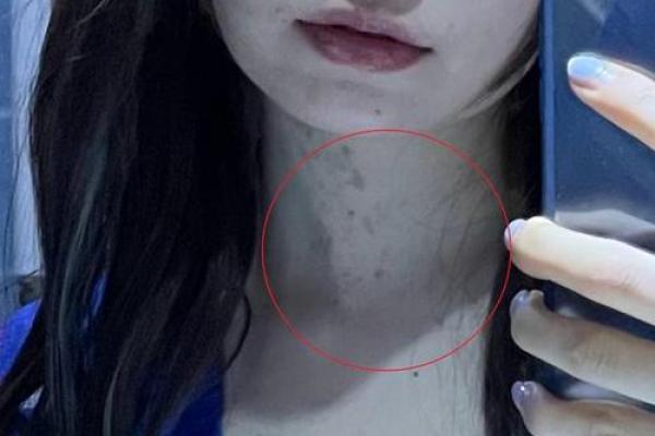 脖子上不同位置胎记算命