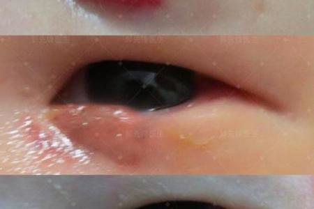 胎记释义，胎记算命中代表什么
