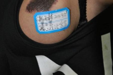 黑色胎记算命分析