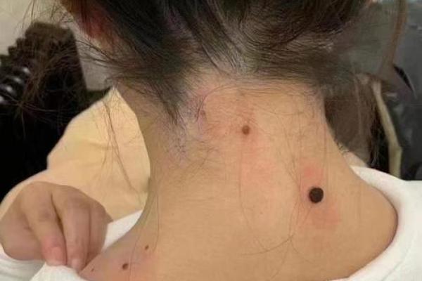风水上女生脖子后面有痣代表什么啊