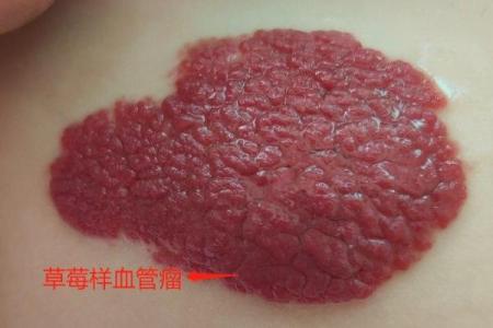 红色胎记算命分析